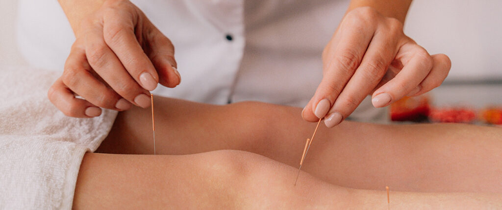 acupuncture