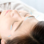 Facial Acupuncture