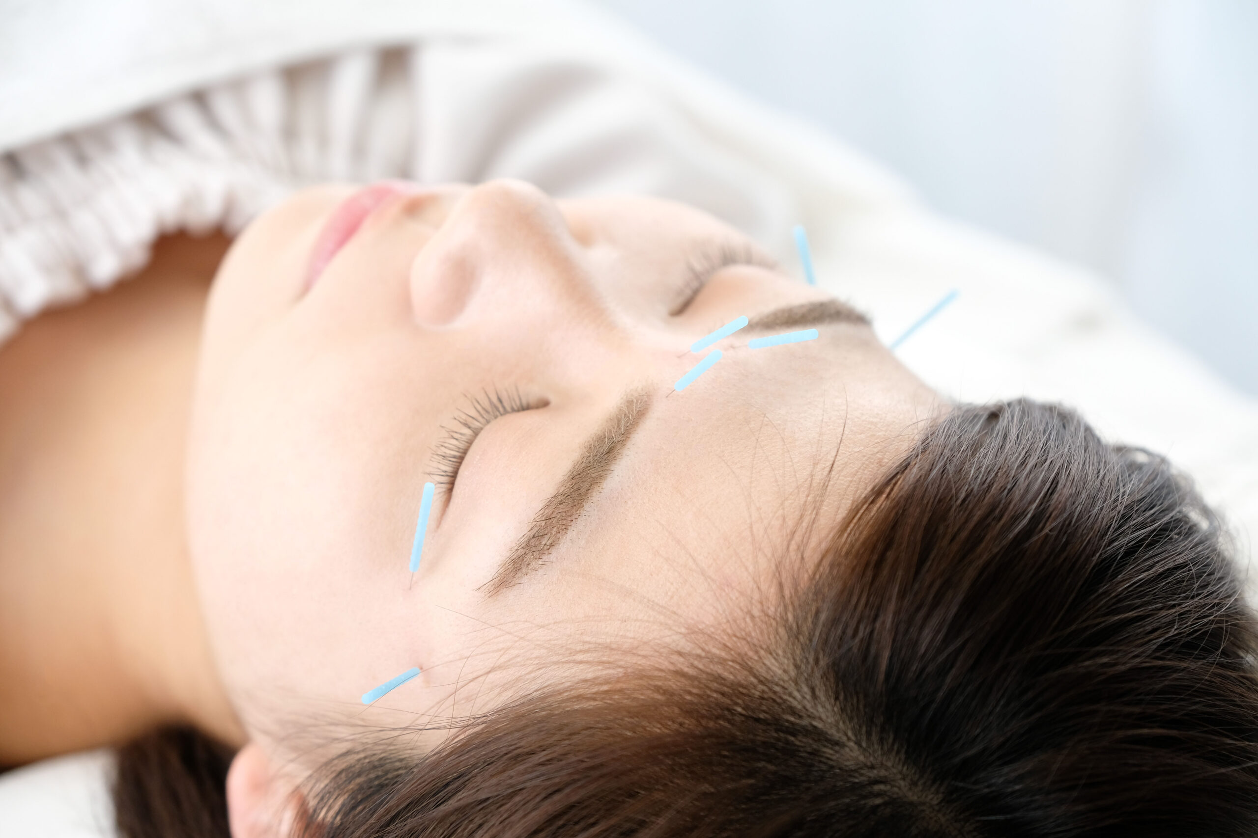 Facial Acupuncture